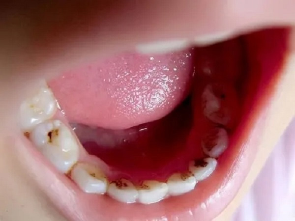 上海51岁助孕生子：如果3岁孩子的牙齿已经烂了，空了，不及时补上会后悔，该怎么办？